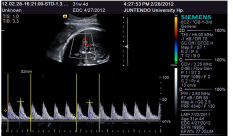 Response measured with Doppler device